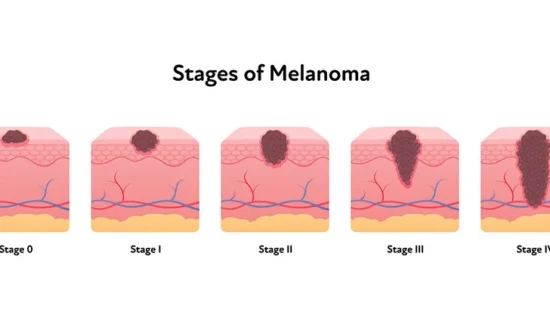 stages-melanoma-890